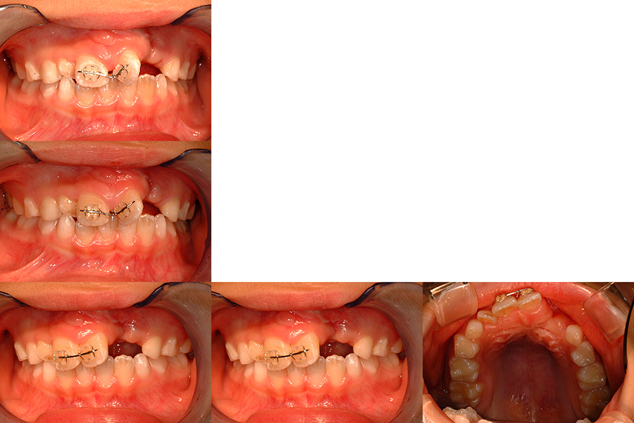口唇口蓋裂の治療例（Ⅰ期治療）　左側口唇顎裂に起因する上顎前歯部叢生　骨移植前の動的治療中　口腔内